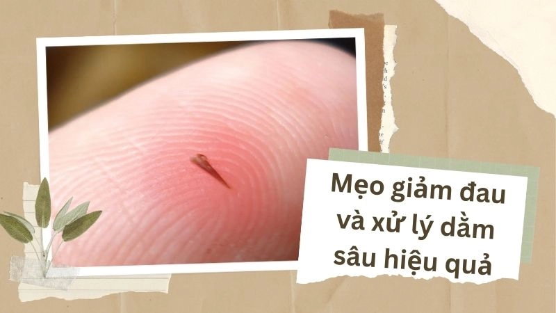 Mẹo giảm đau và xử lý dằm sâu hiệu quả